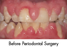 GUM SURGERY