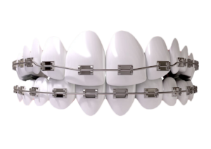 METAL BRACES