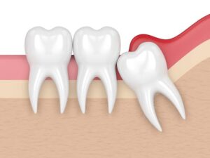 3RD MOLAR EXTRACTION