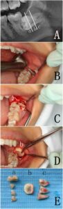 IMPACTION