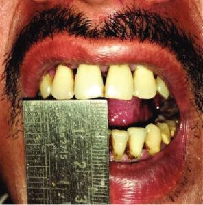 REDUCE MOUTH OPNING